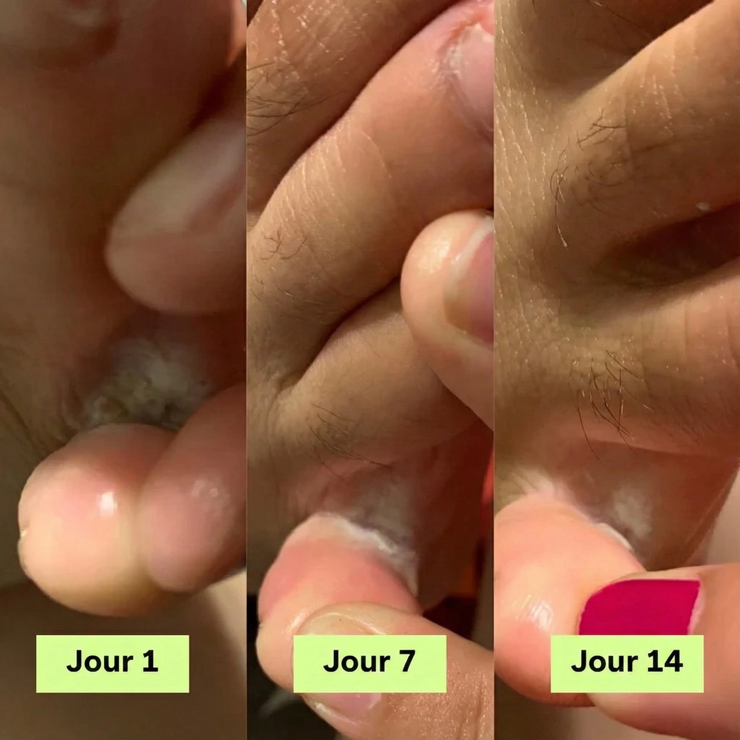 Savon Antifongique Anti-Mycose