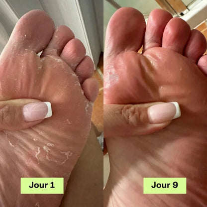 Savon Antifongique Anti-Mycose