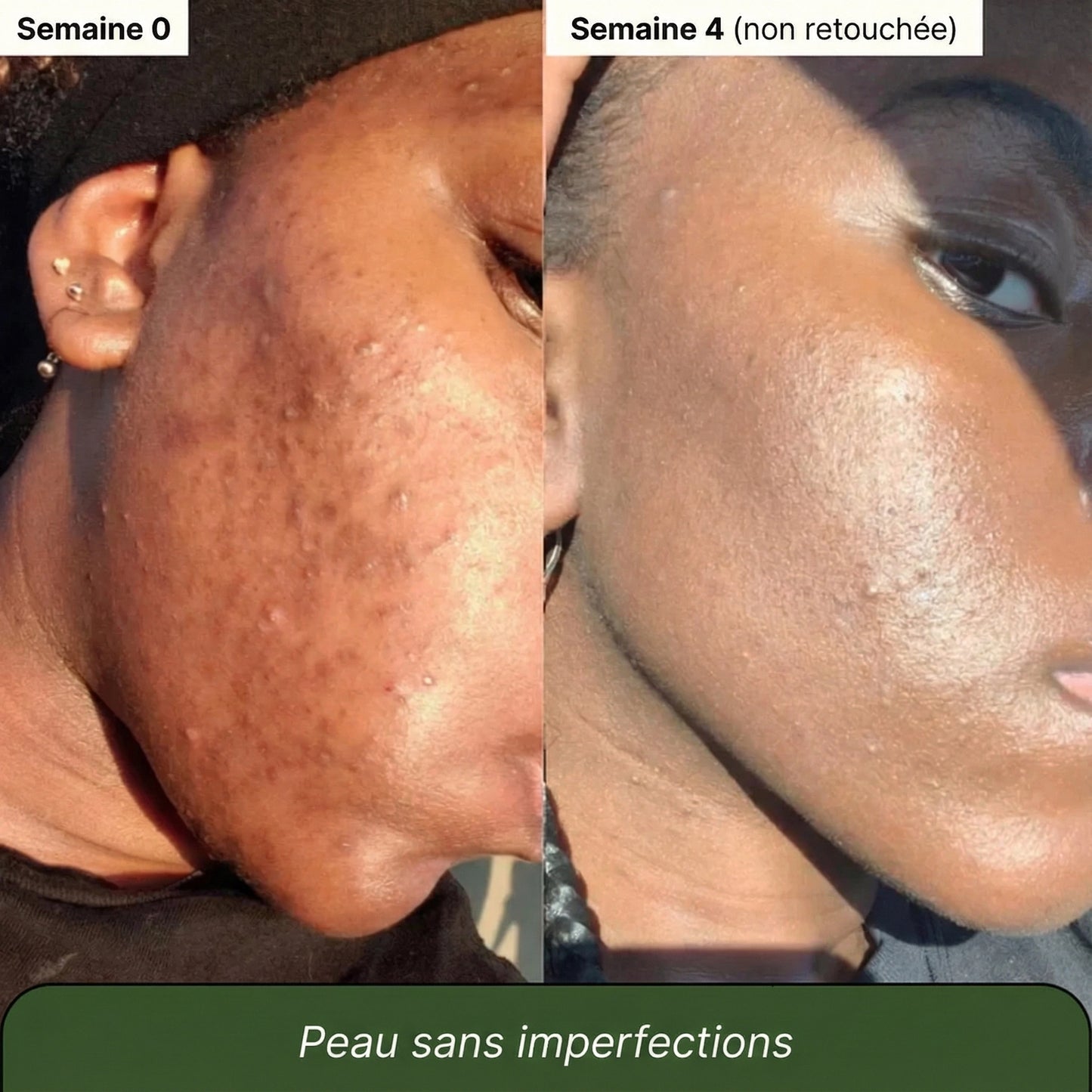 Savon au Curcuma et à l'Acide Kojique